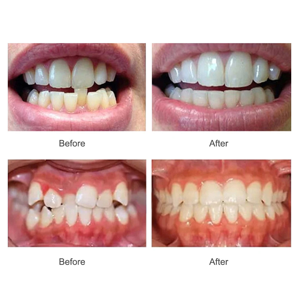 Dental Accessories, 3 Stages Dental Braces, Teeth Trainer, Alignment Mouthpiece, Tooth Orthodontic Brace Straightener For Adults